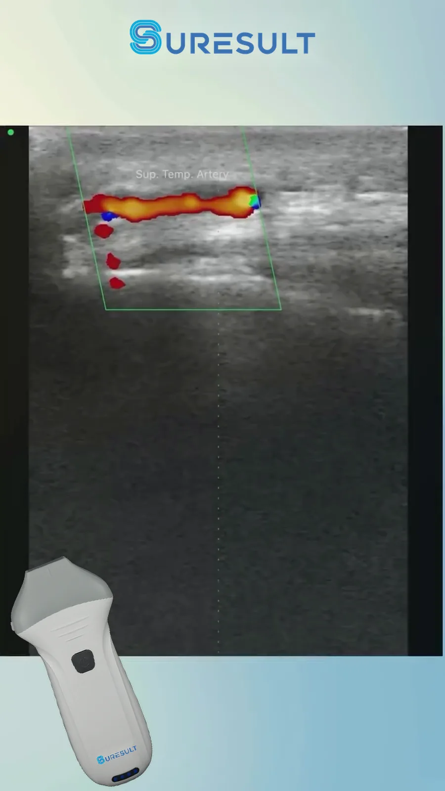 Oppervlakkige temporale arterie · Kleurendoppler · Pro Series scanvoorbeeld
