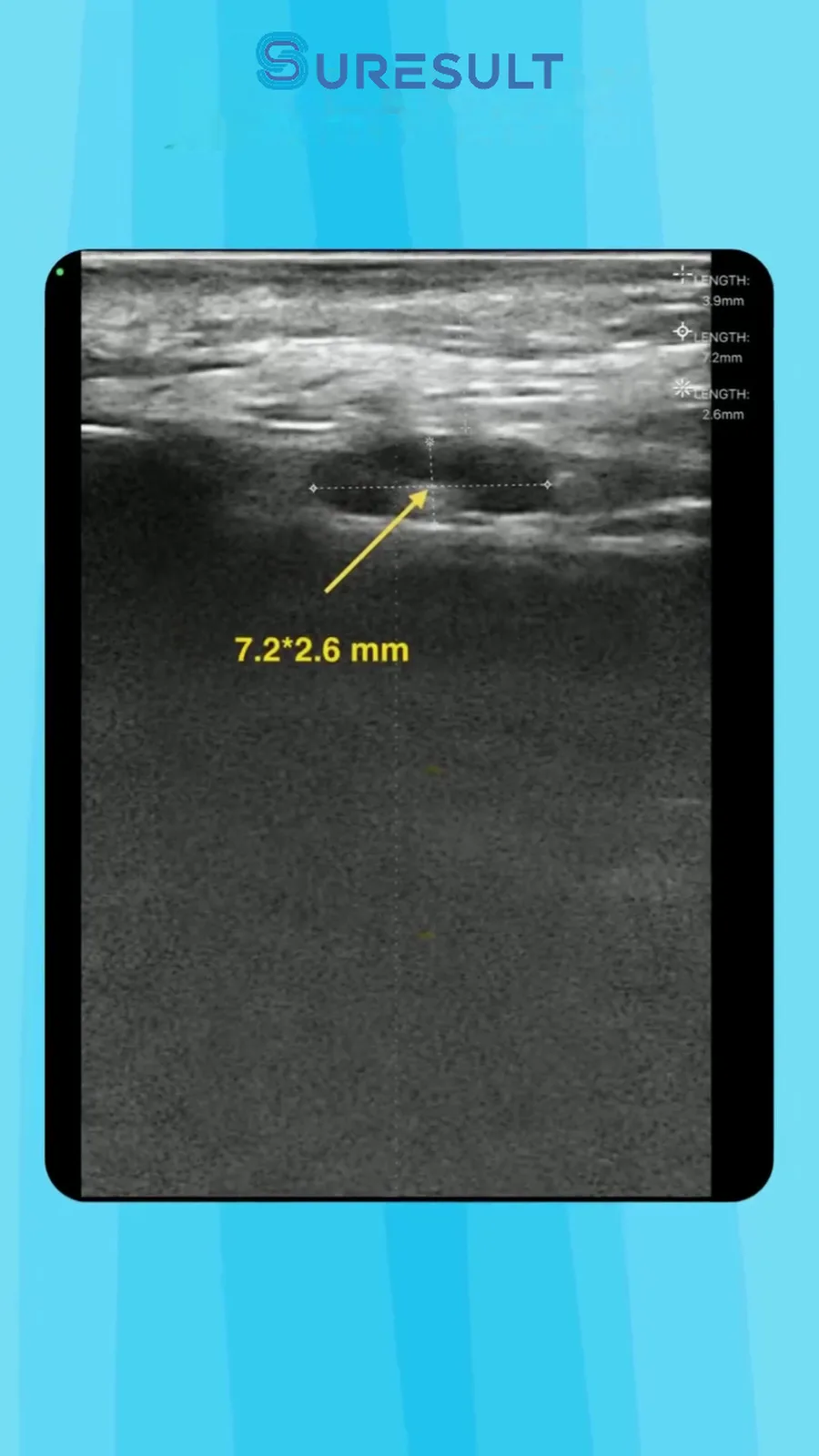 Lymfeklier in de parotisregio · B-mode · Pro Series scanvoorbeeld