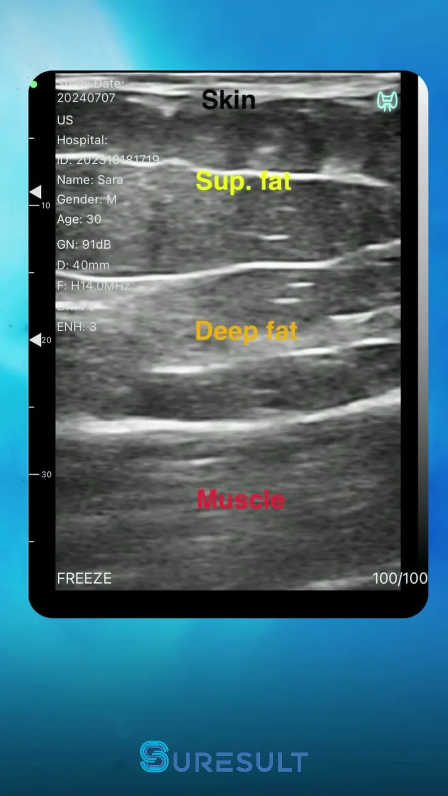 Gluteale huid-, vet- en spierlagen · B-mode · Pro Series scanvoorbeeld