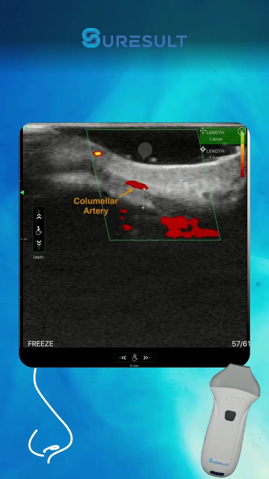 Arteria columellaris · Powerdoppler · Pro Series – scanvoorbeeld
