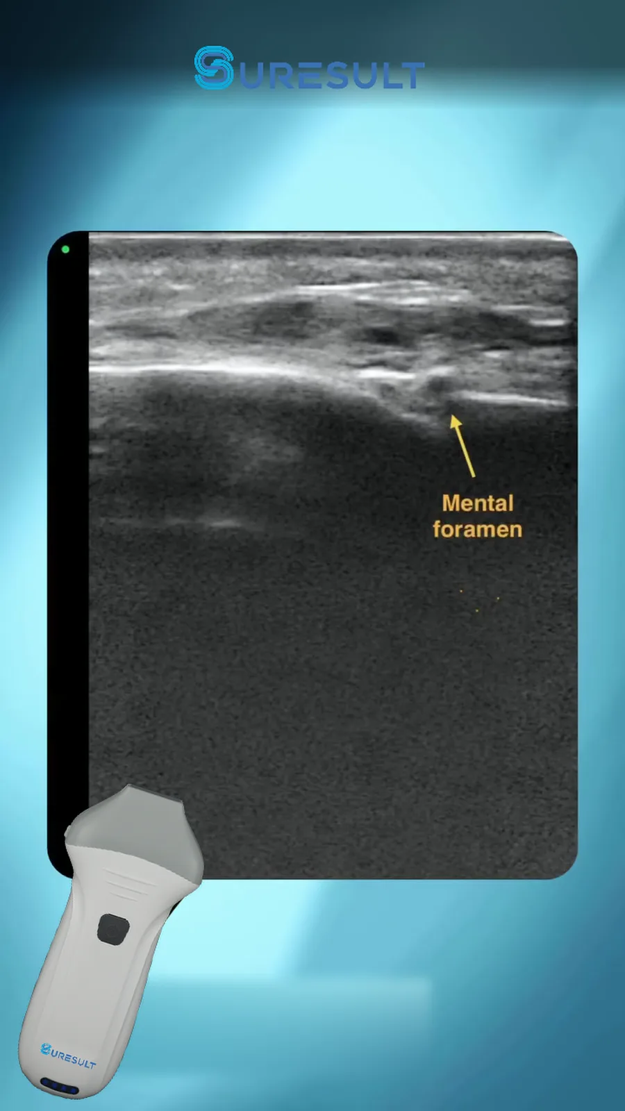 Foramen mentale · B-mode · Pro Series scanvoorbeeld