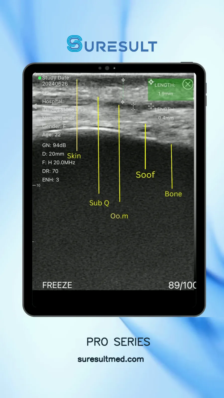 Diepte orbicularis oculi · B-mode · Pro Series scanvoorbeeld
