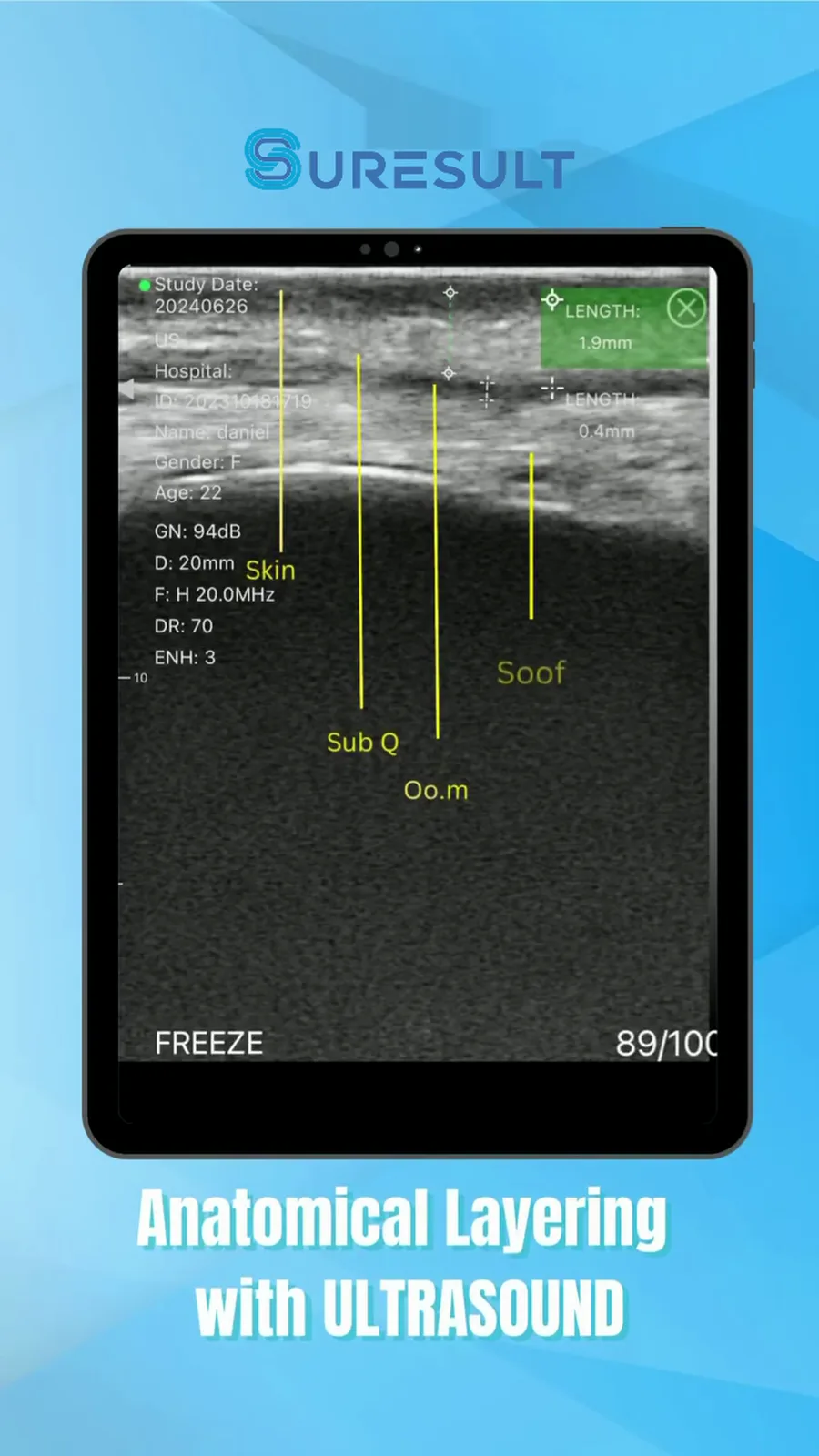 Weefsellagen kraaienpootjes · B-mode · Pro Series scanvoorbeeld