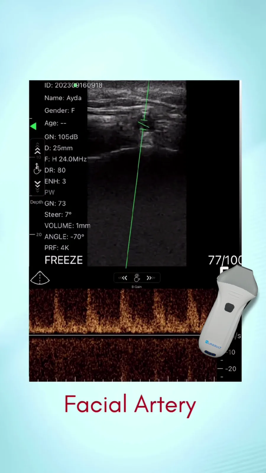 Arteria facialis vs. vena facialis · PW-doppler · Pro Series scanvoorbeeld