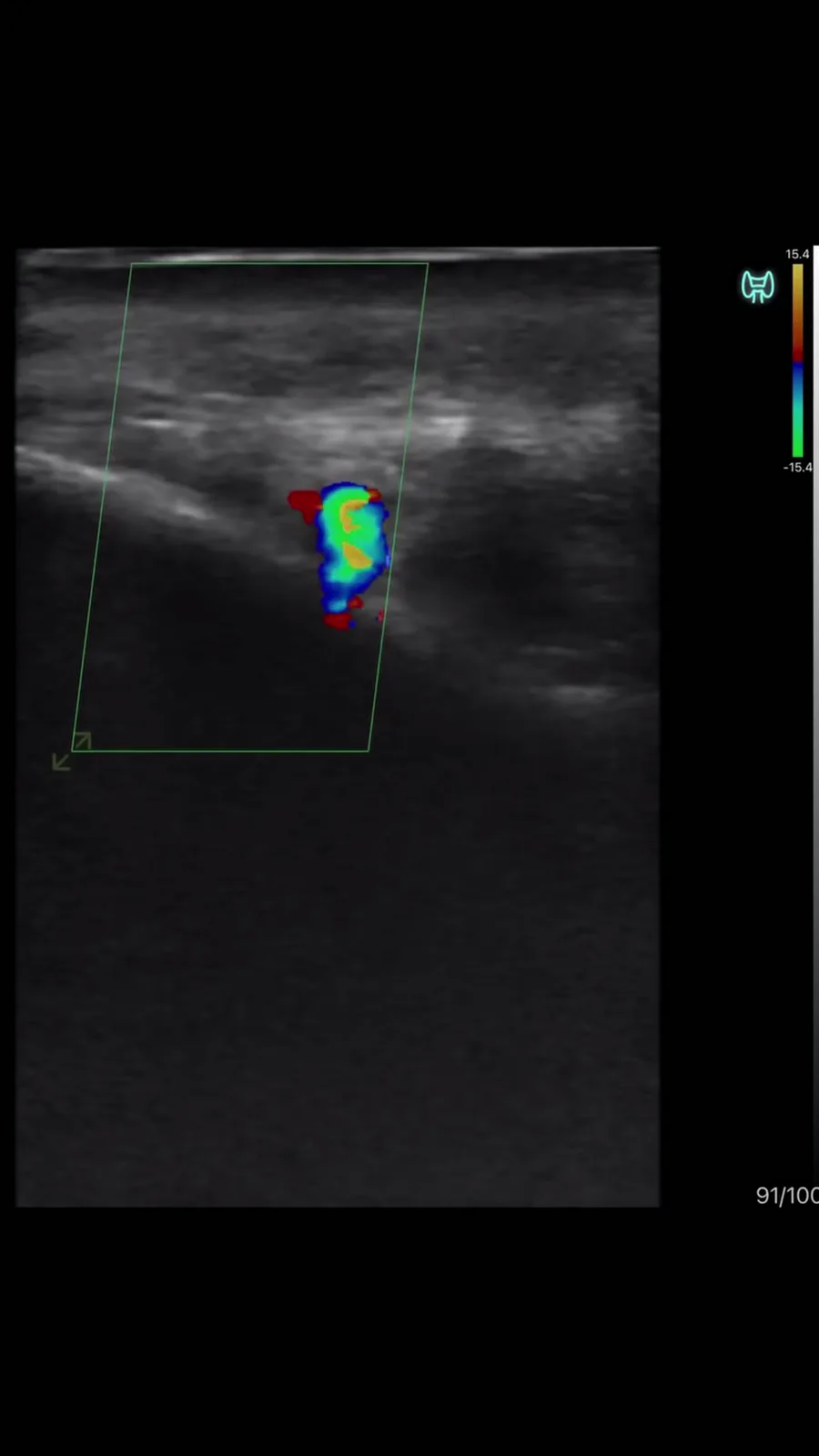 Lagen van de slaap, diepe temporale arterie · B-mode · Pro Series scanvoorbeeld