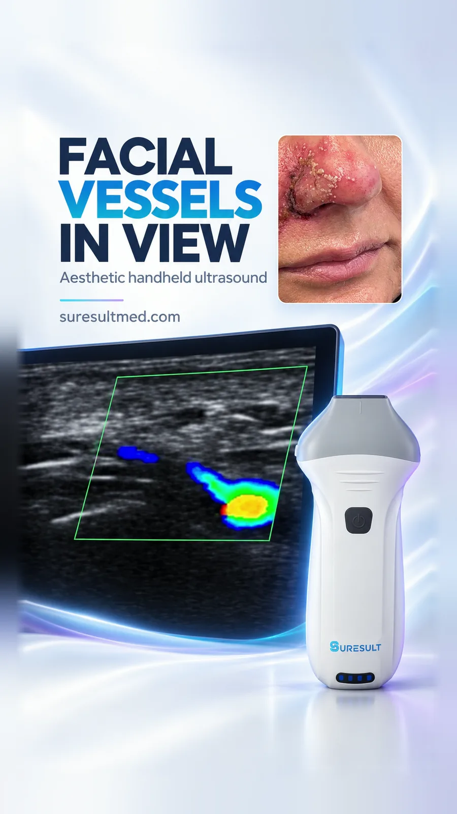 Arteria angularis na een fillerincident · Kleurendoppler · Pro Series scanvoorbeeld