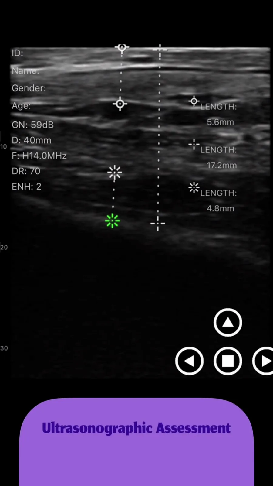 PCL-filler in de slaap · B-mode · Pro Series scanvoorbeeld