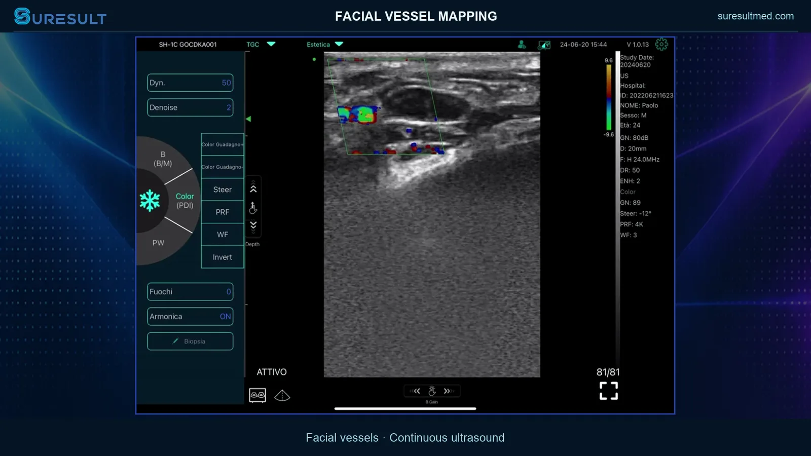 Vaatmapping van het gezicht, volledige sessie · Kleurendoppler · Pro Series scanvoorbeeld