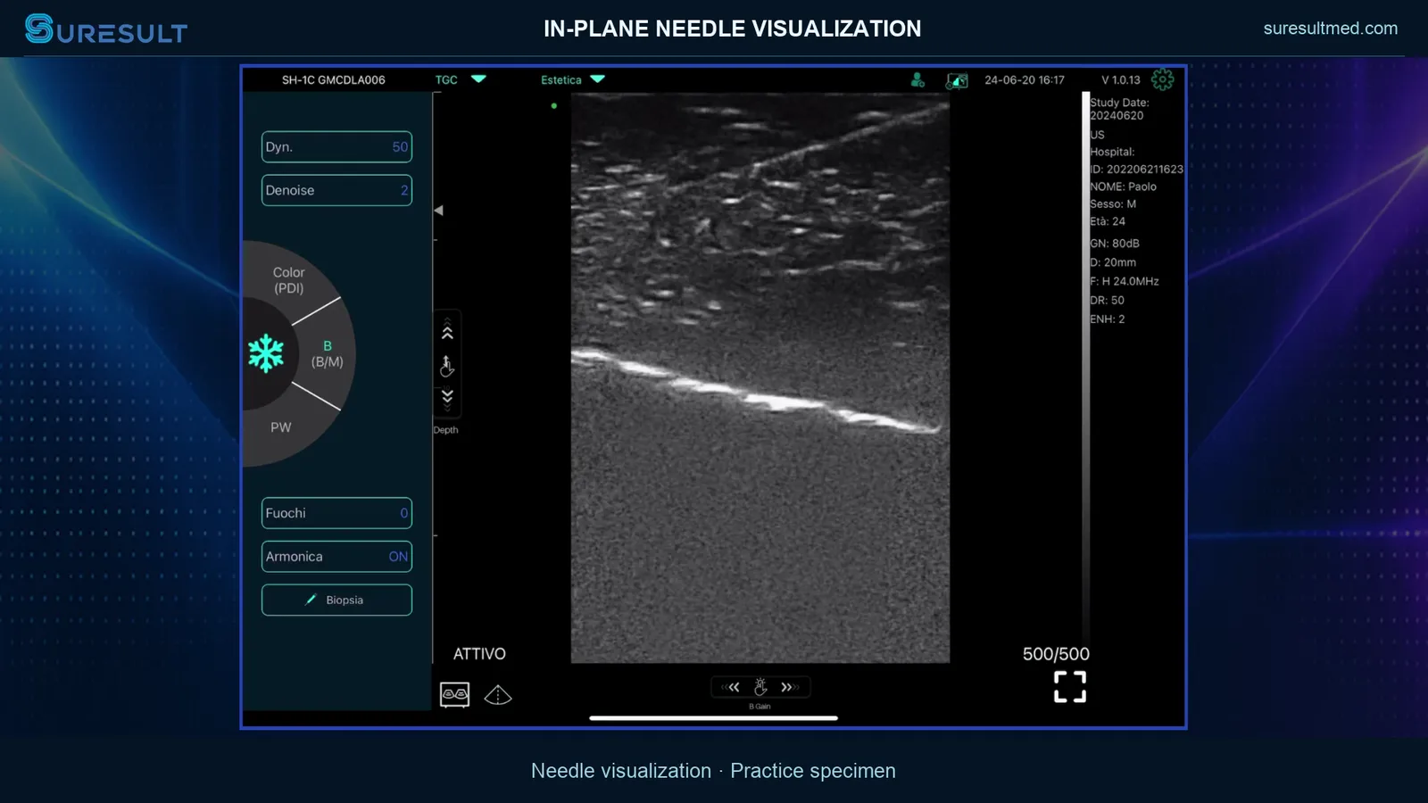 In-plane naaldvisualisatie · B-mode · Pro Series scanvoorbeeld