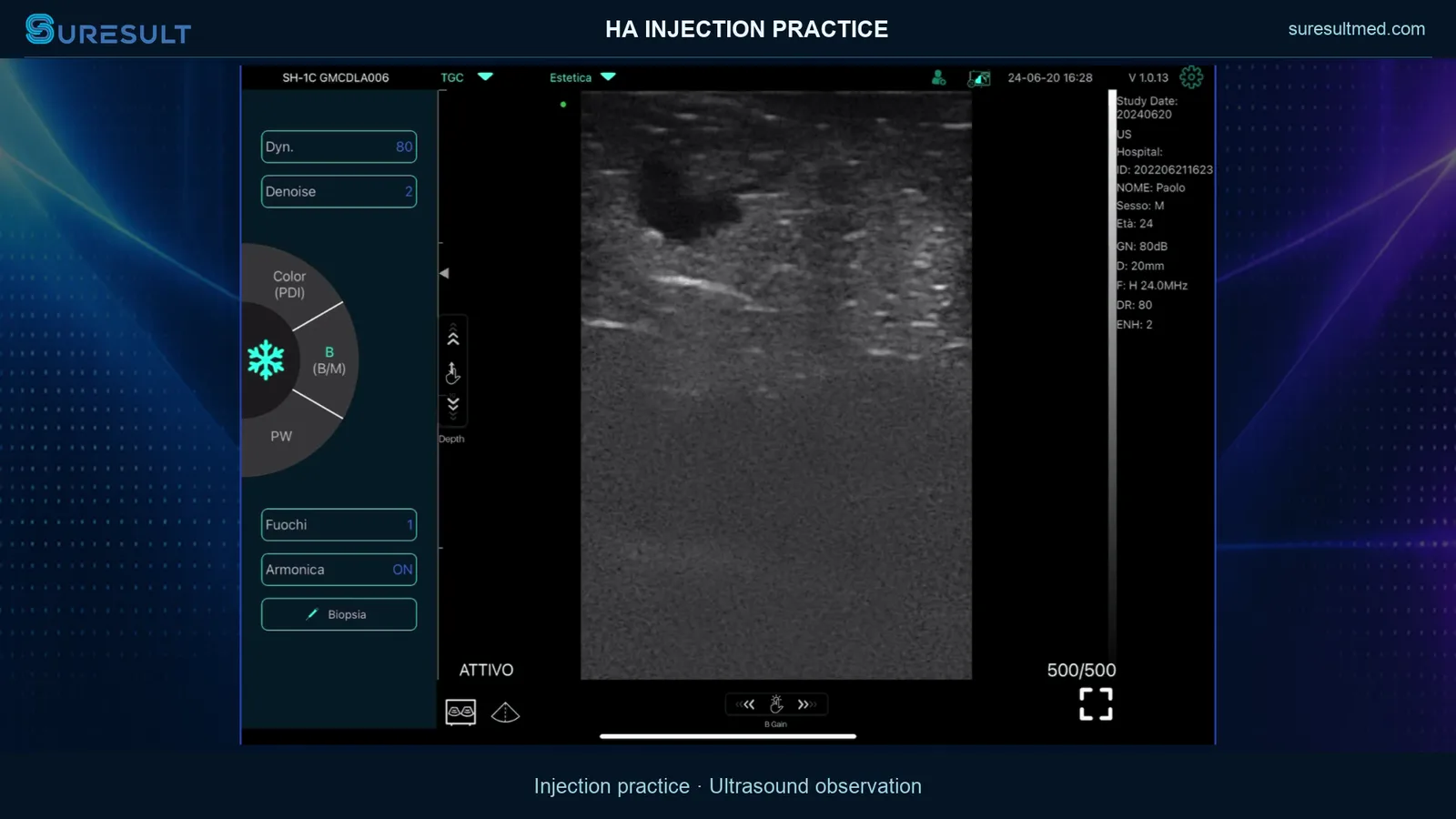 HA-injectieoefening met calipers · B-mode · Pro Series scanvoorbeeld