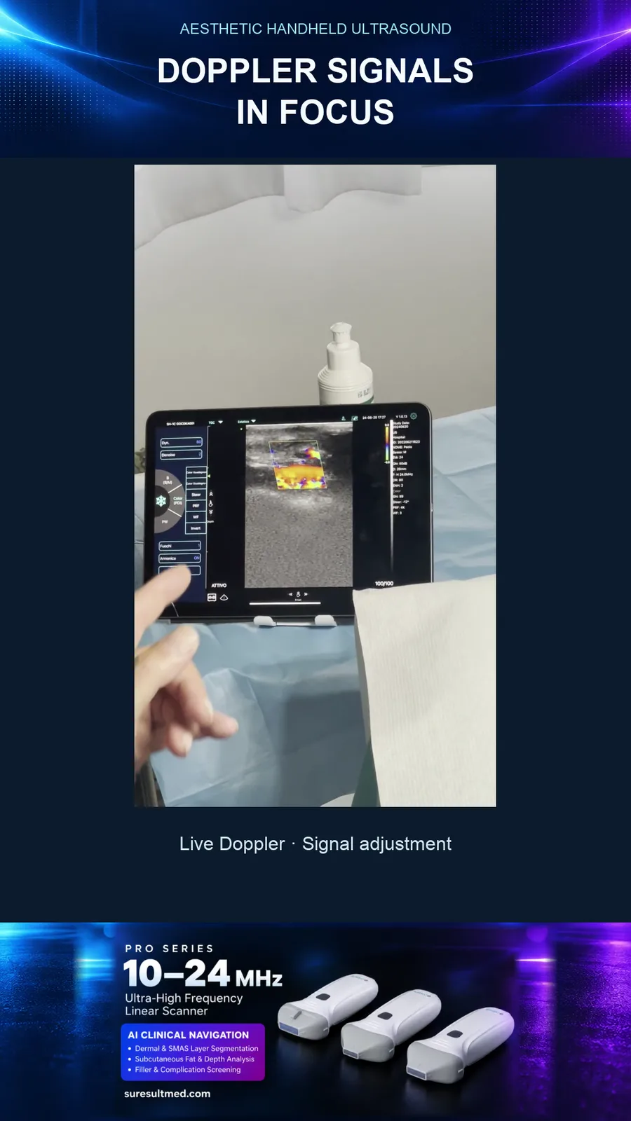 Doppler-PRF op een aangezichtsvat · Kleurendoppler · Pro Series scanvoorbeeld