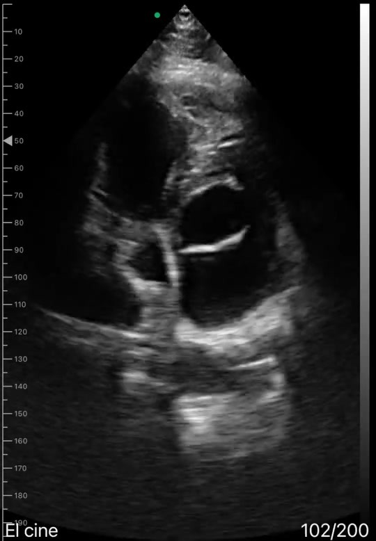 Cardiac view · POCUS · D3Ultra · Phased array scan preview
