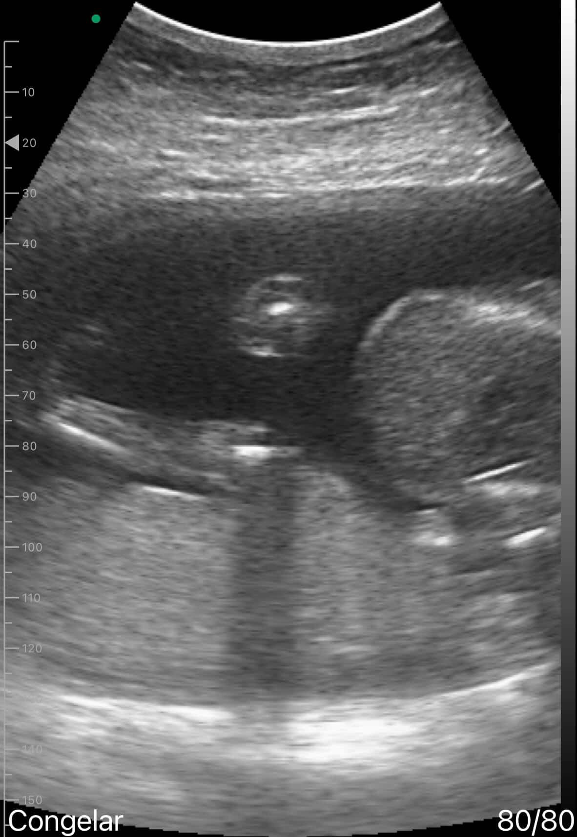 Abdomen · B-mode · D3Ultra · Convex probe scan preview