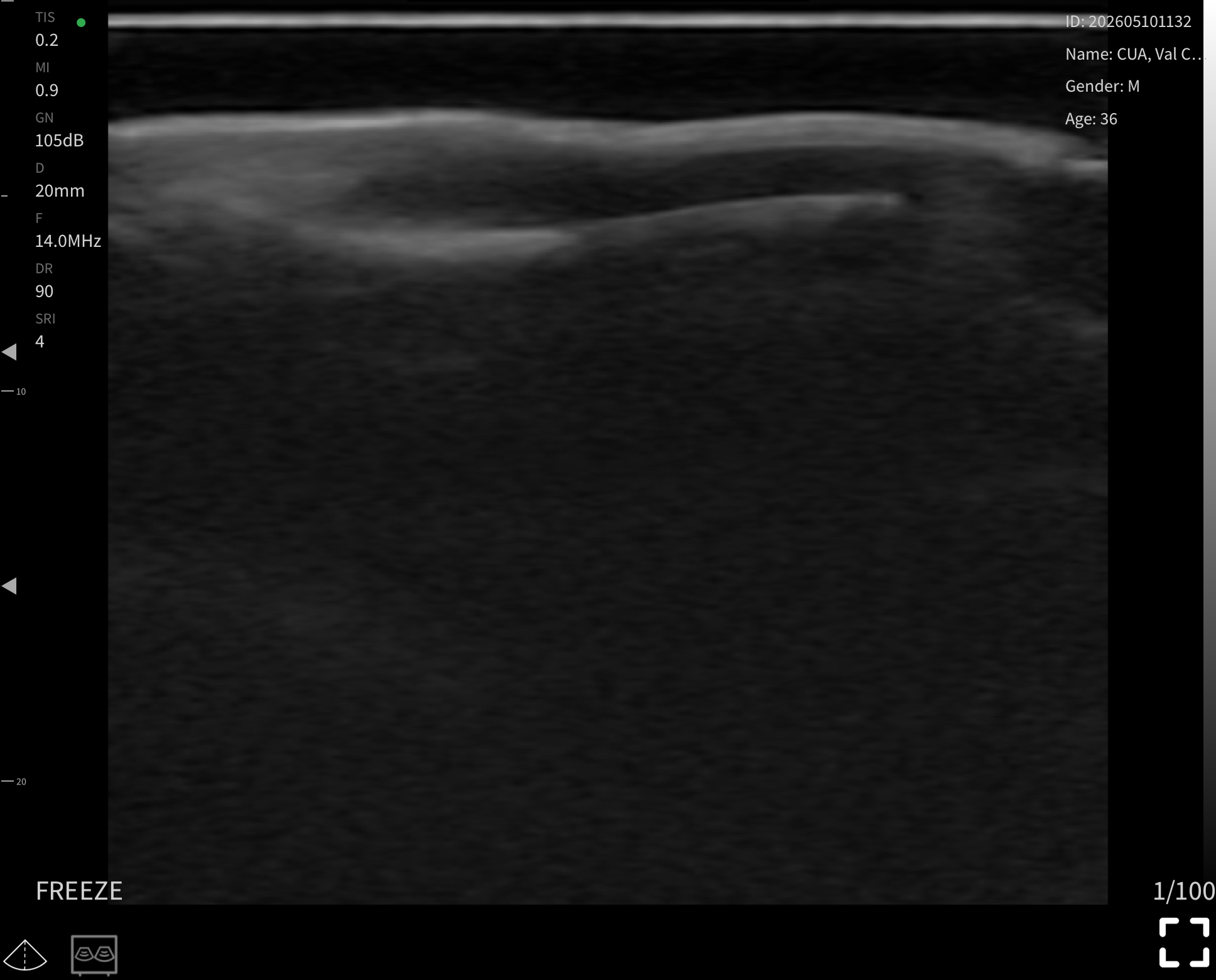 Nail unit, longitudinal · B-mode · L24Pro · 14 MHz scan preview