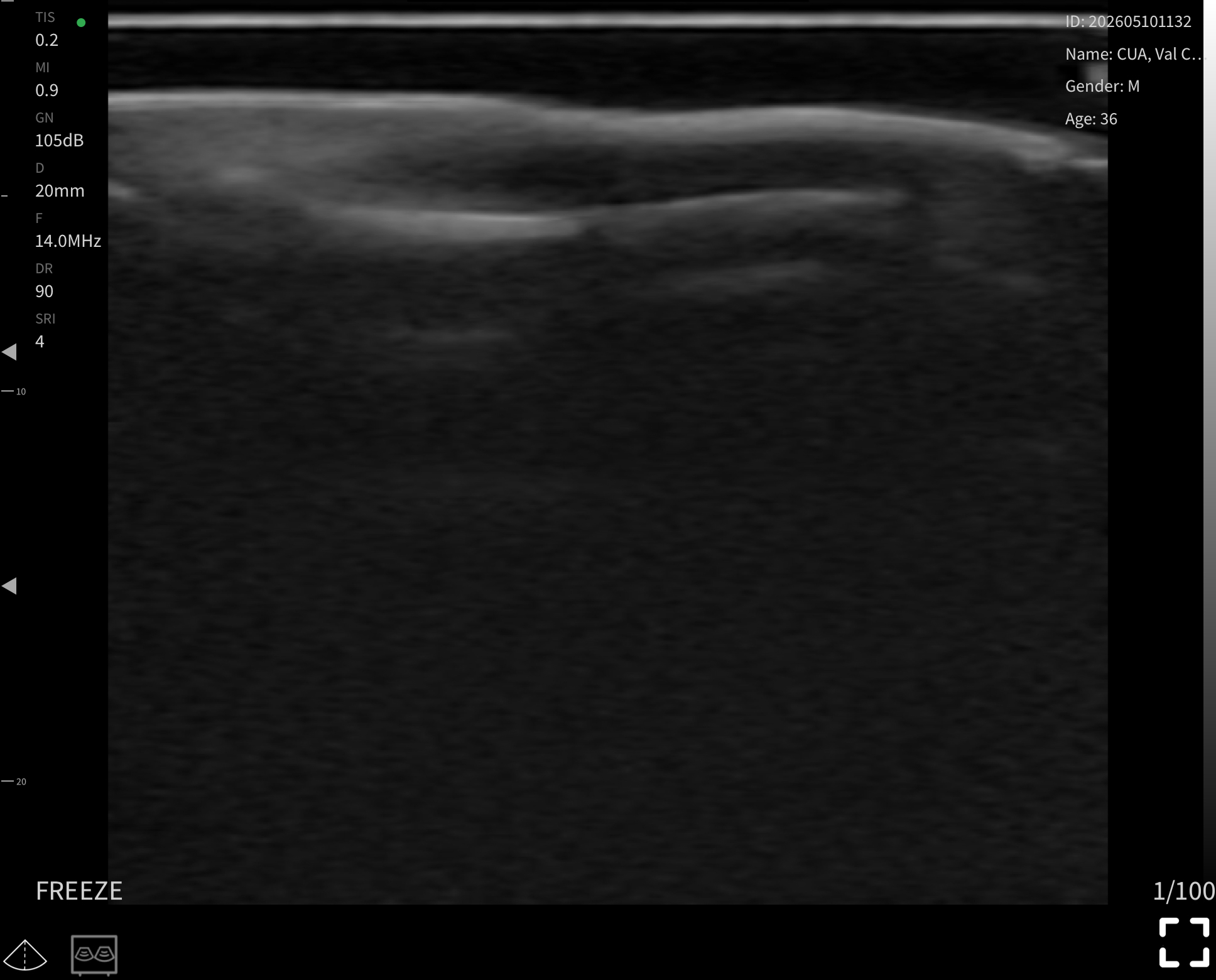 Nail unit, longitudinal 2 · B-mode · L24Pro · 14 MHz scan preview
