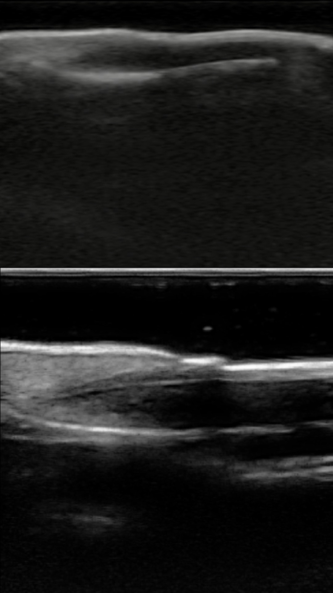 Nail unit comparison · B-mode · L24Pro · Linear probe scan preview
