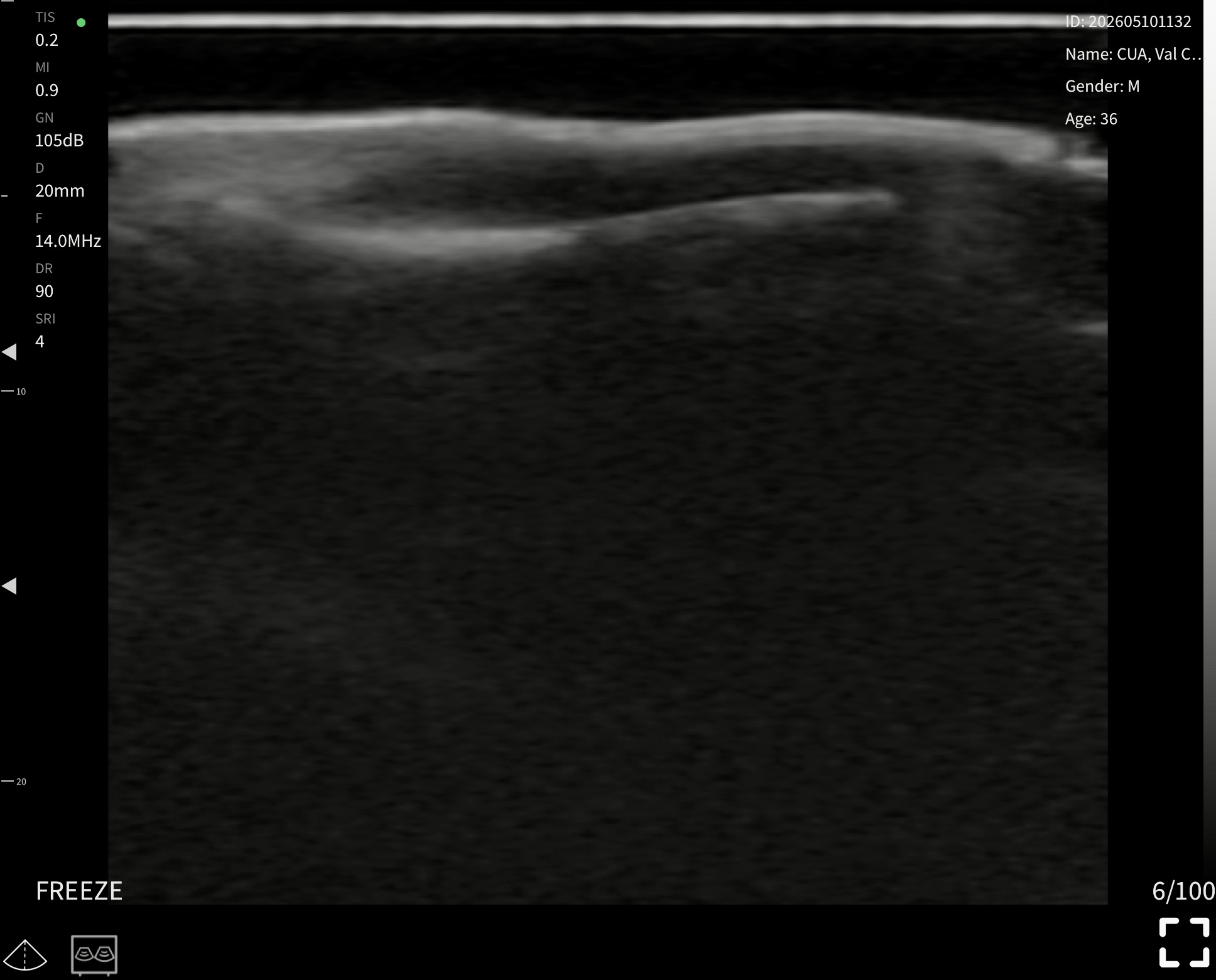 Nail unit, longitudinal 3 · B-mode · L24Pro · 14 MHz scan preview