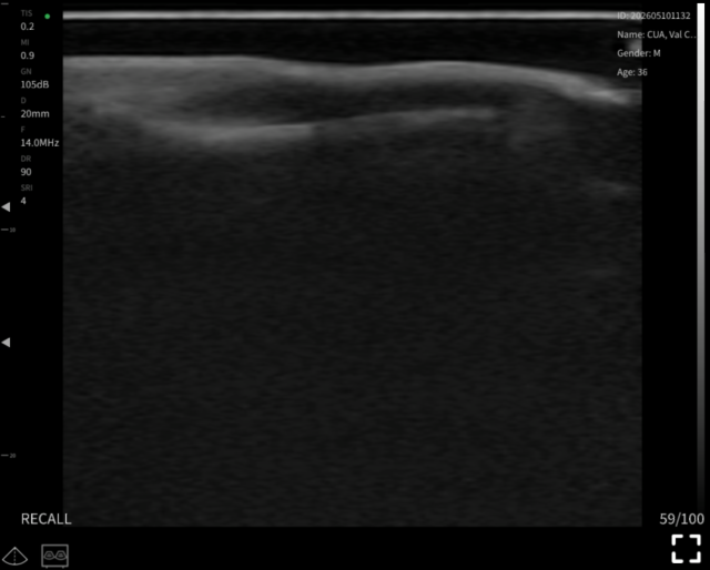 Nail unit, longitudinal 2 · B-mode · L24Pro · Linear probe scan preview