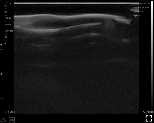 Nail unit, longitudinal 3 · B-mode · L24Pro · Linear probe scan preview