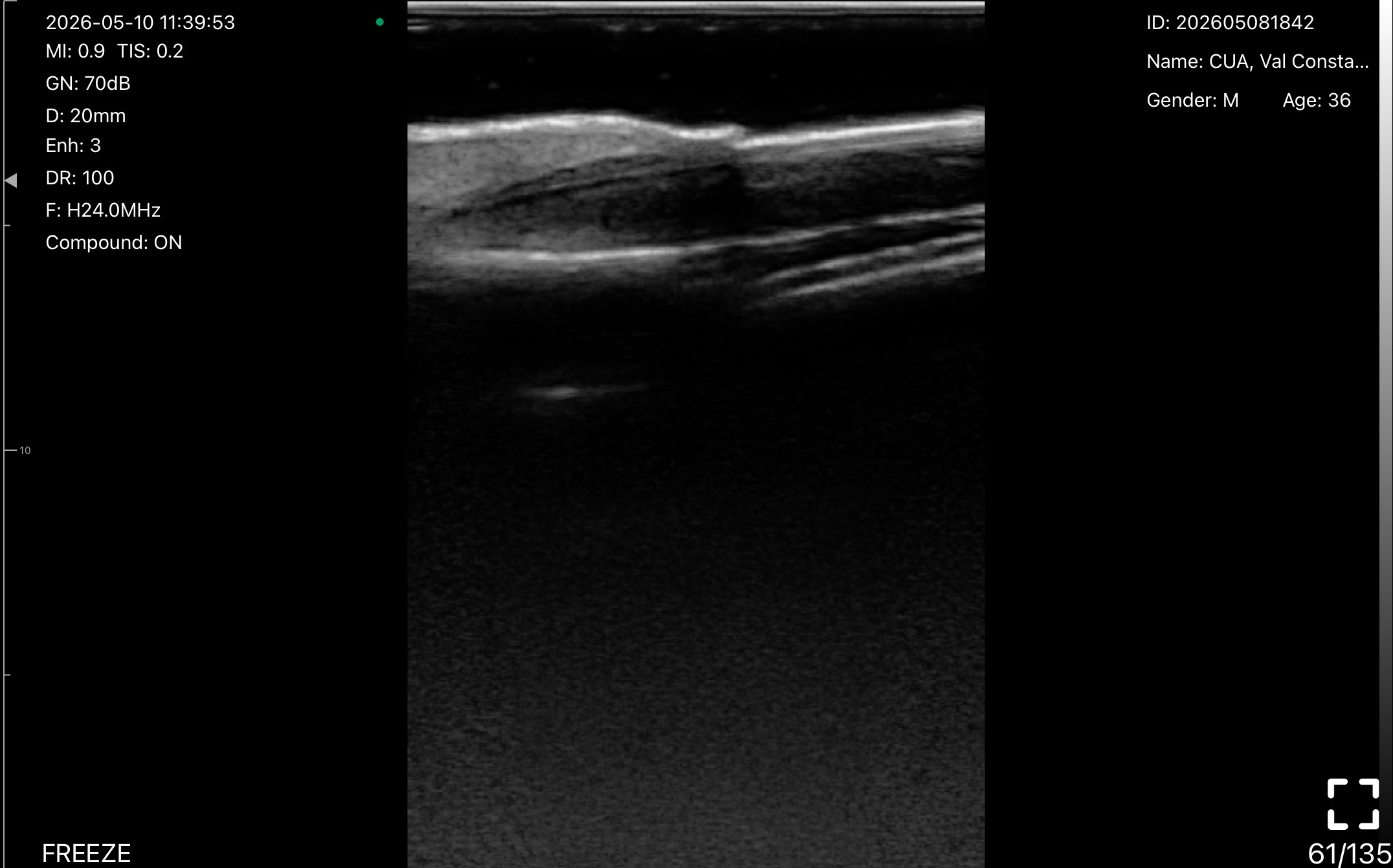 Nail unit, longitudinal 4 · B-mode · L24Pro · Linear probe scan preview