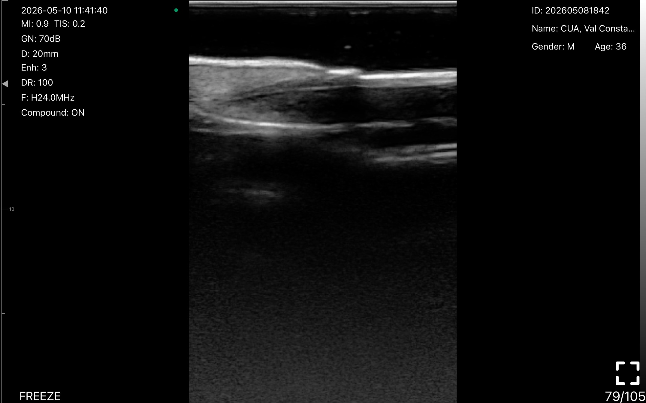 Nail unit, longitudinal 2 · B-mode · L24Pro · 24 MHz scan preview