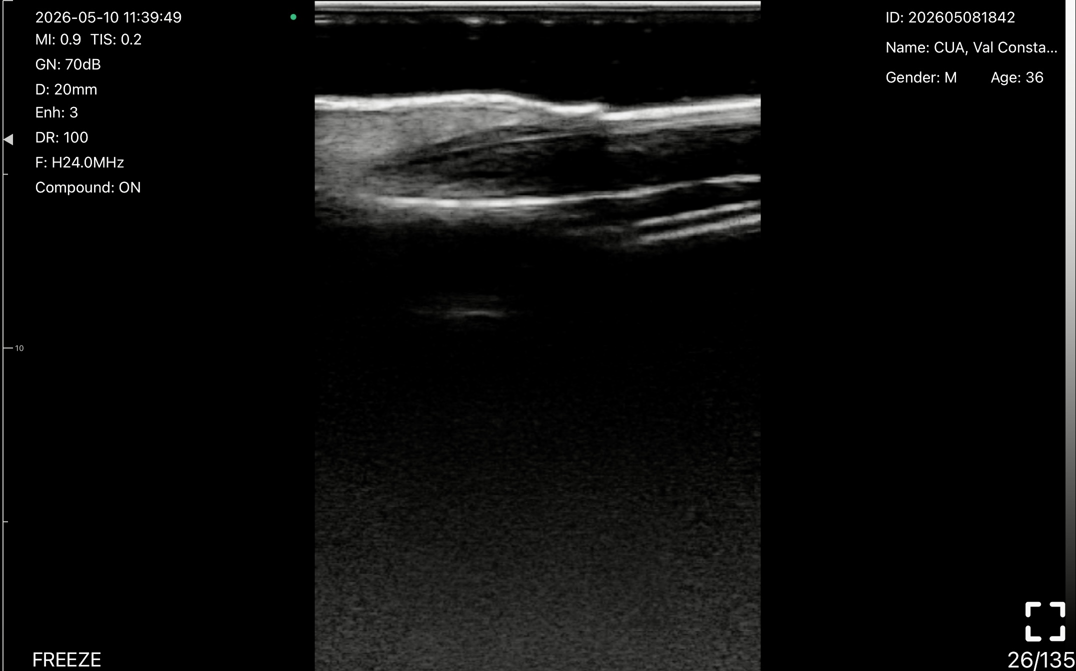 Nail unit, longitudinal 5 · B-mode · L24Pro · Linear probe scan preview