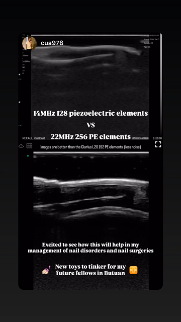 Nail unit 2 · B-mode · L24Pro · Linear probe scan preview