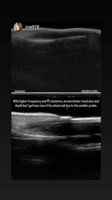 Nail unit 3 · B-mode · L24Pro · Linear probe scan preview