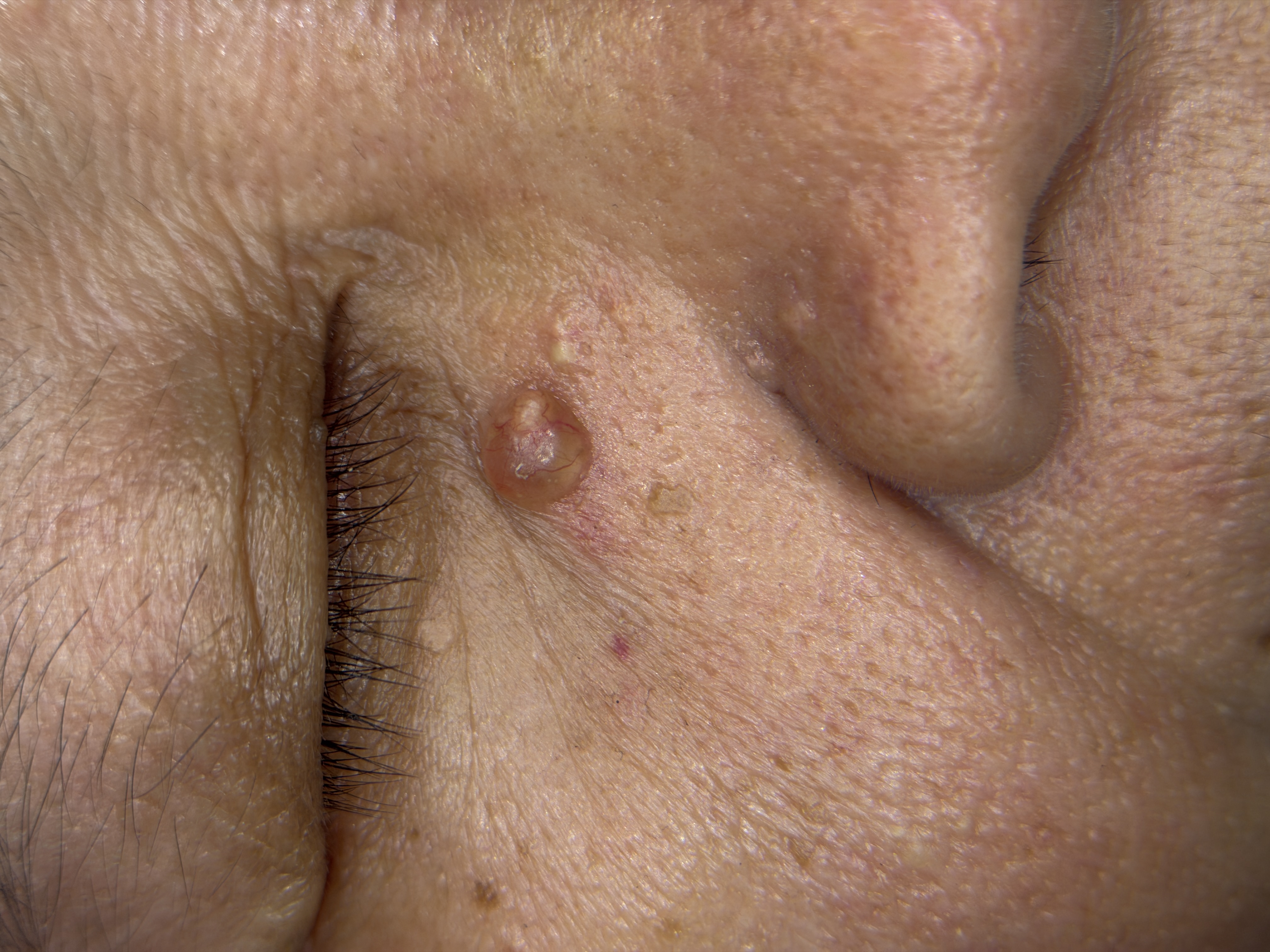 Facial skin tumour, clinical photo · Clinical photo · L24Pro scan preview