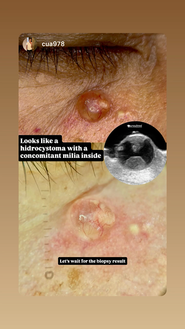 Facial superficial tissue 2 · B-mode · L24Pro · Linear probe scan preview