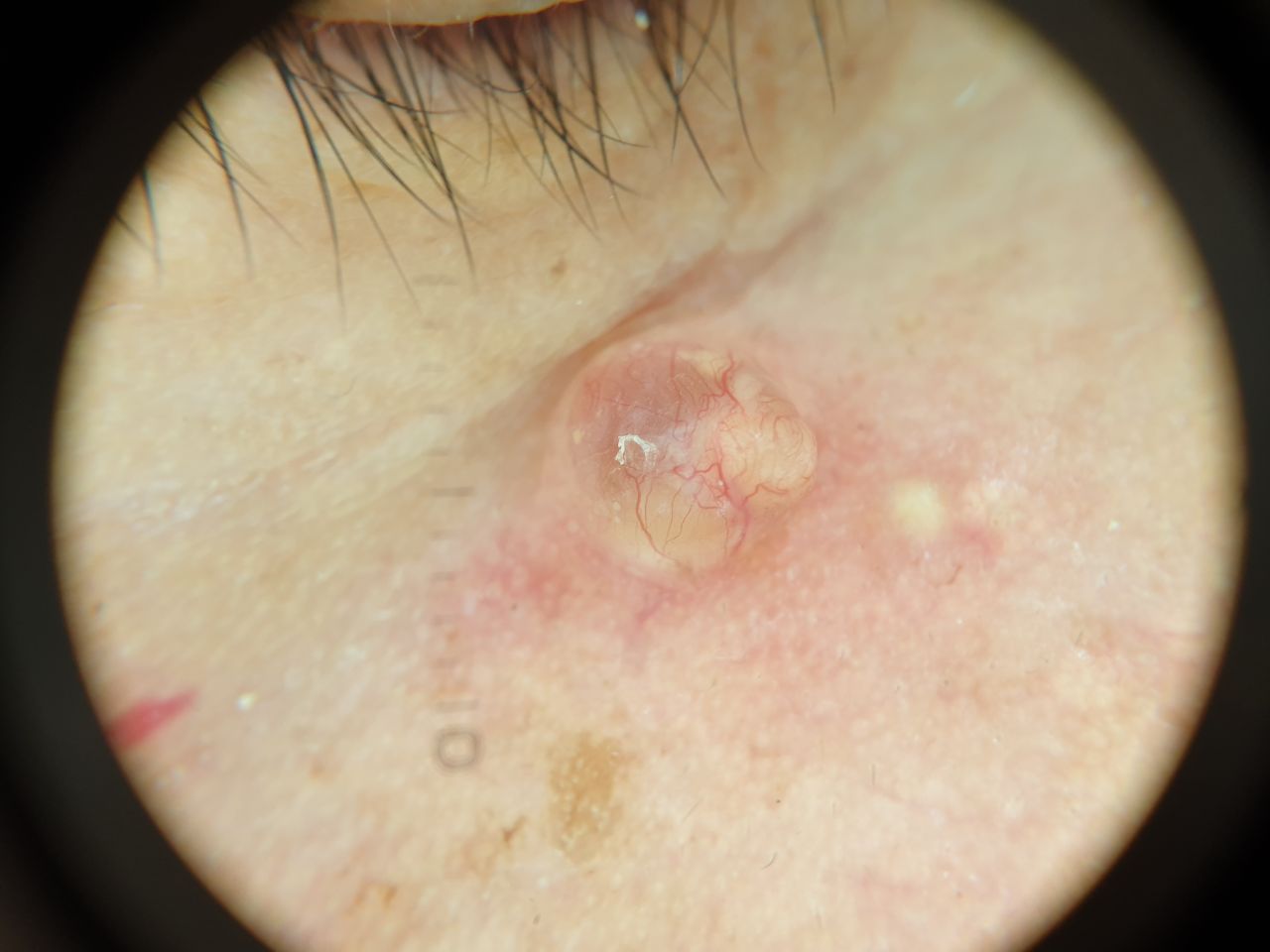Facial skin tumour, dermoscopy photo · Clinical photo · L24Pro scan preview