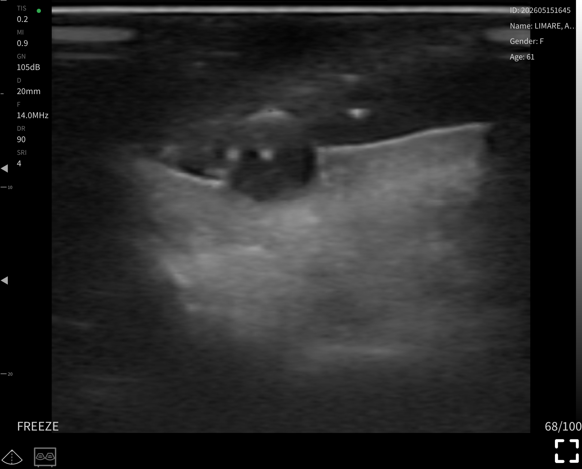 Facial skin tumour · B-mode · L24Pro · 14 MHz scan preview