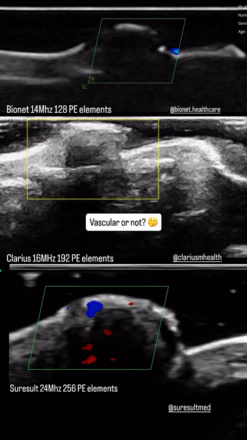 Nail unit fibrokeratoma · B-mode · L24Pro · 18 MHz scan preview
