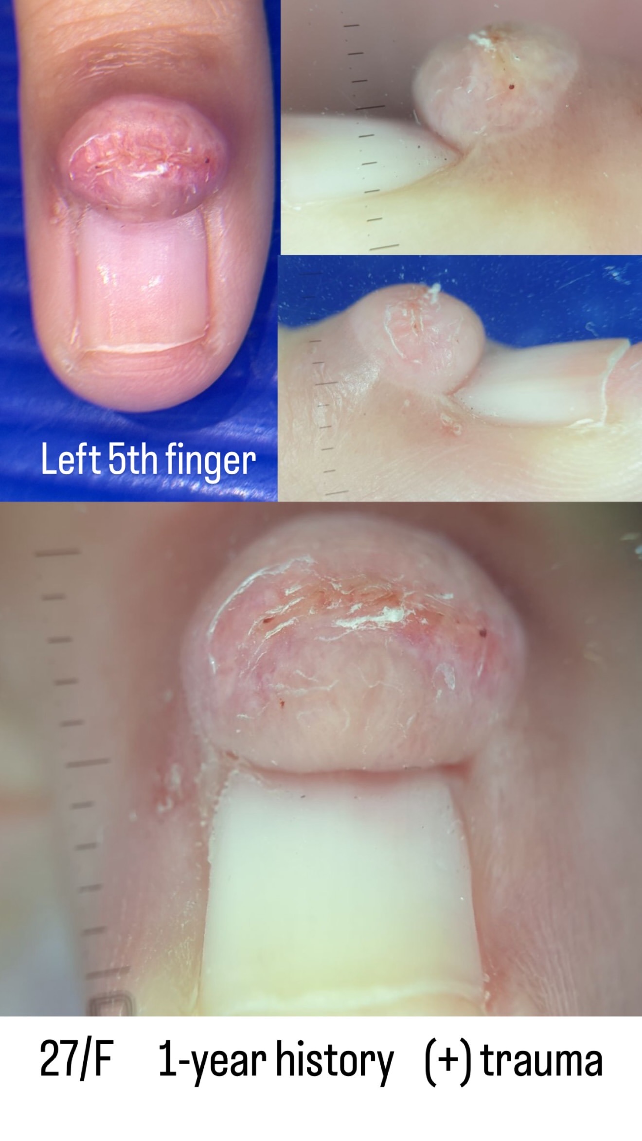 Nail unit fibrokeratoma, clinical photo · Clinical photo · L24Pro scan preview