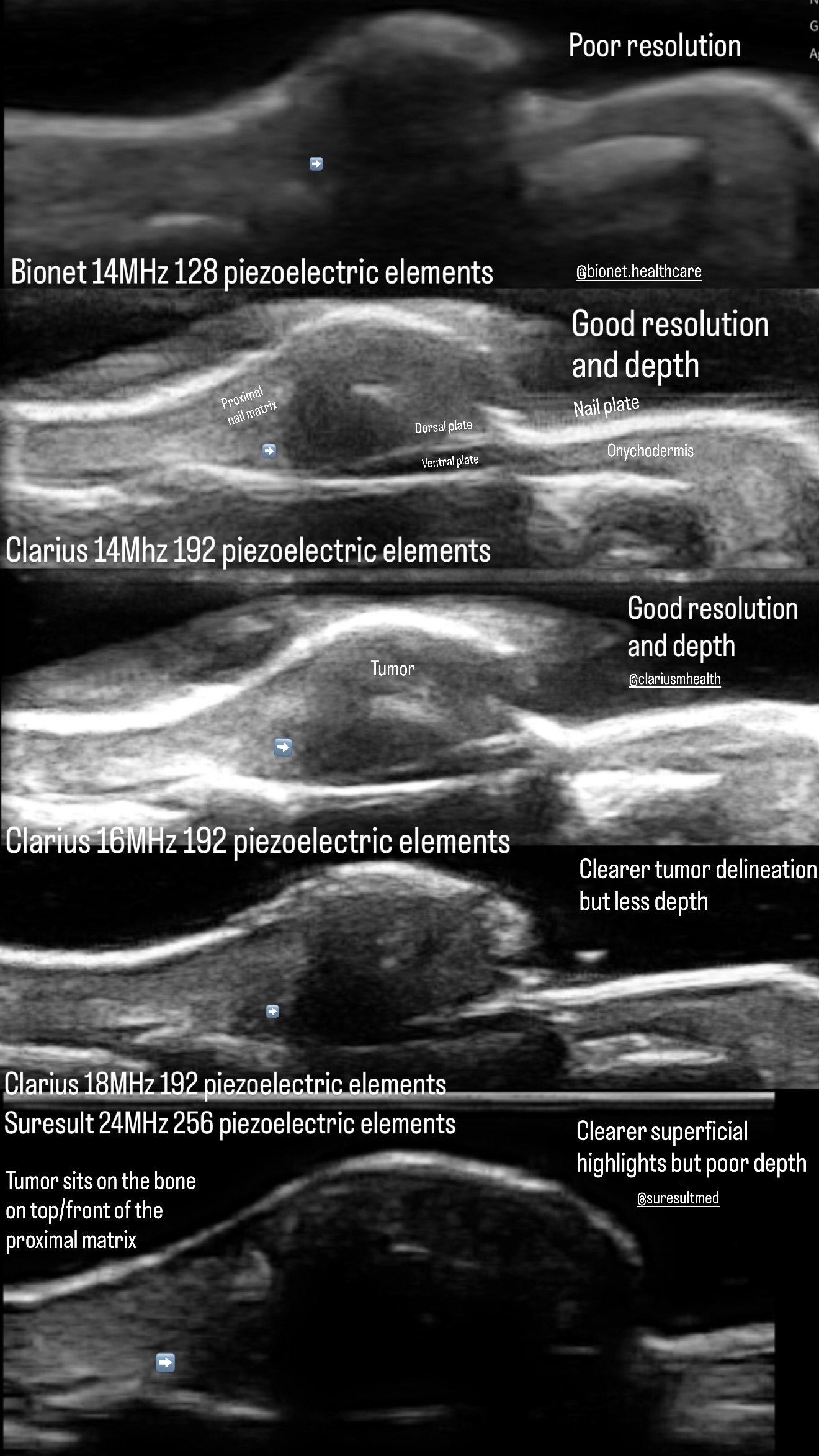 Nail unit fibrokeratoma comparison · B-mode · L24Pro · Linear probe scan preview