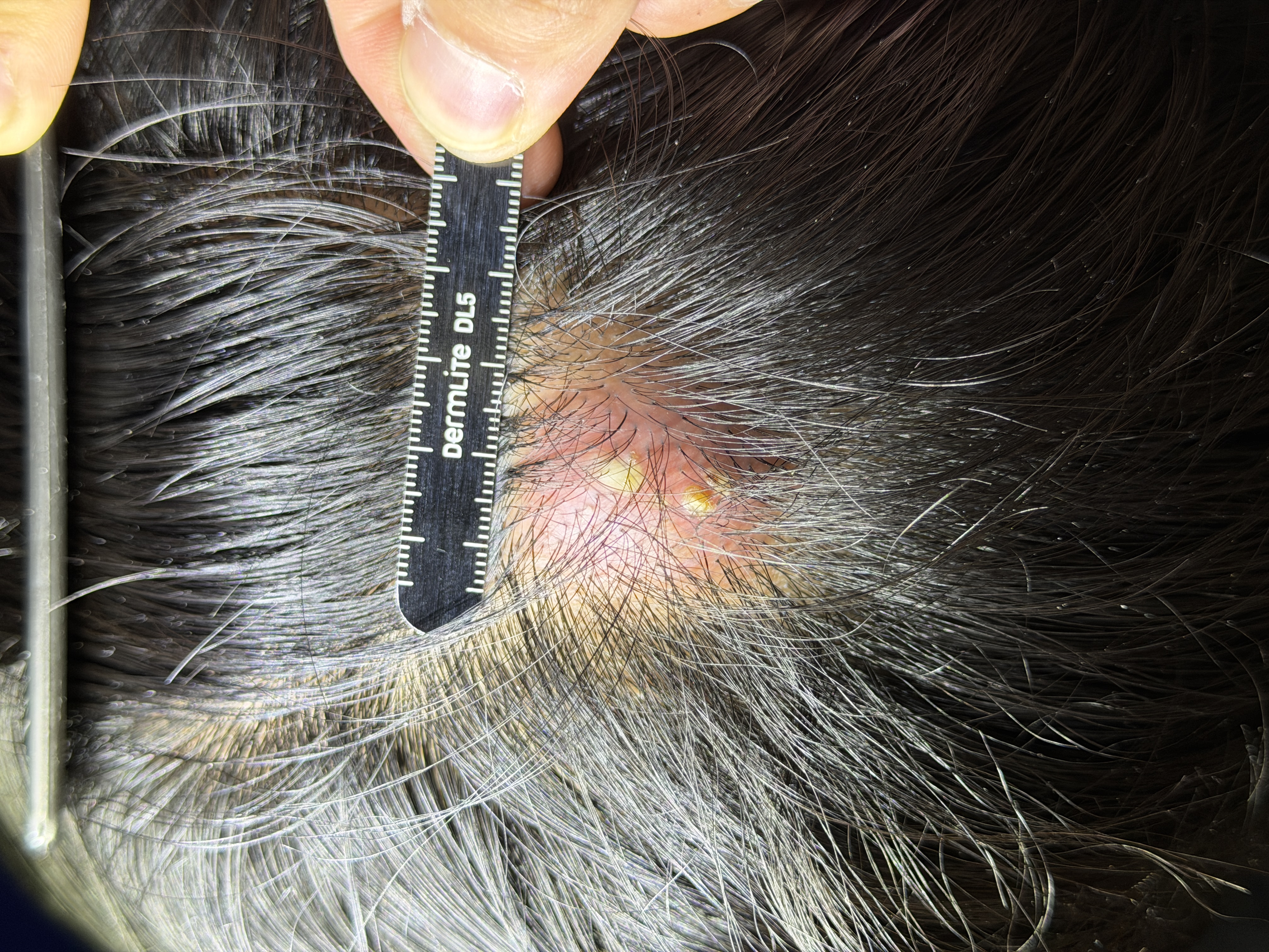 Scalp abscess, clinical photo · Clinical photo · L24Pro · Linear probe scan preview