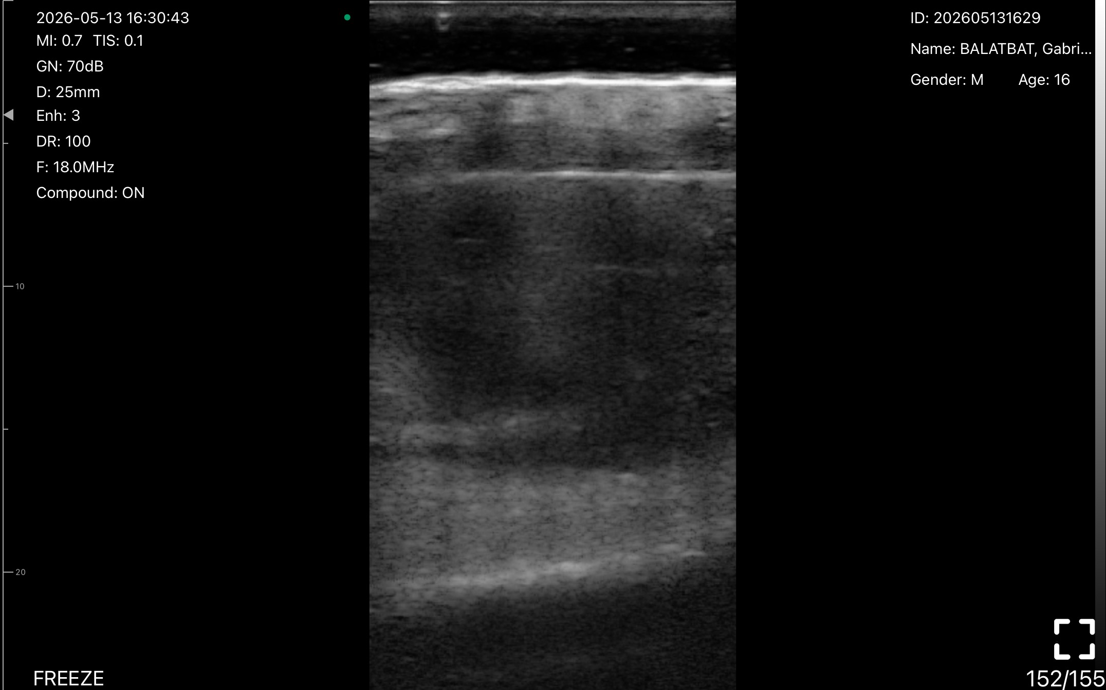 Scalp abscess · B-mode · L24Pro · 18 MHz scan preview