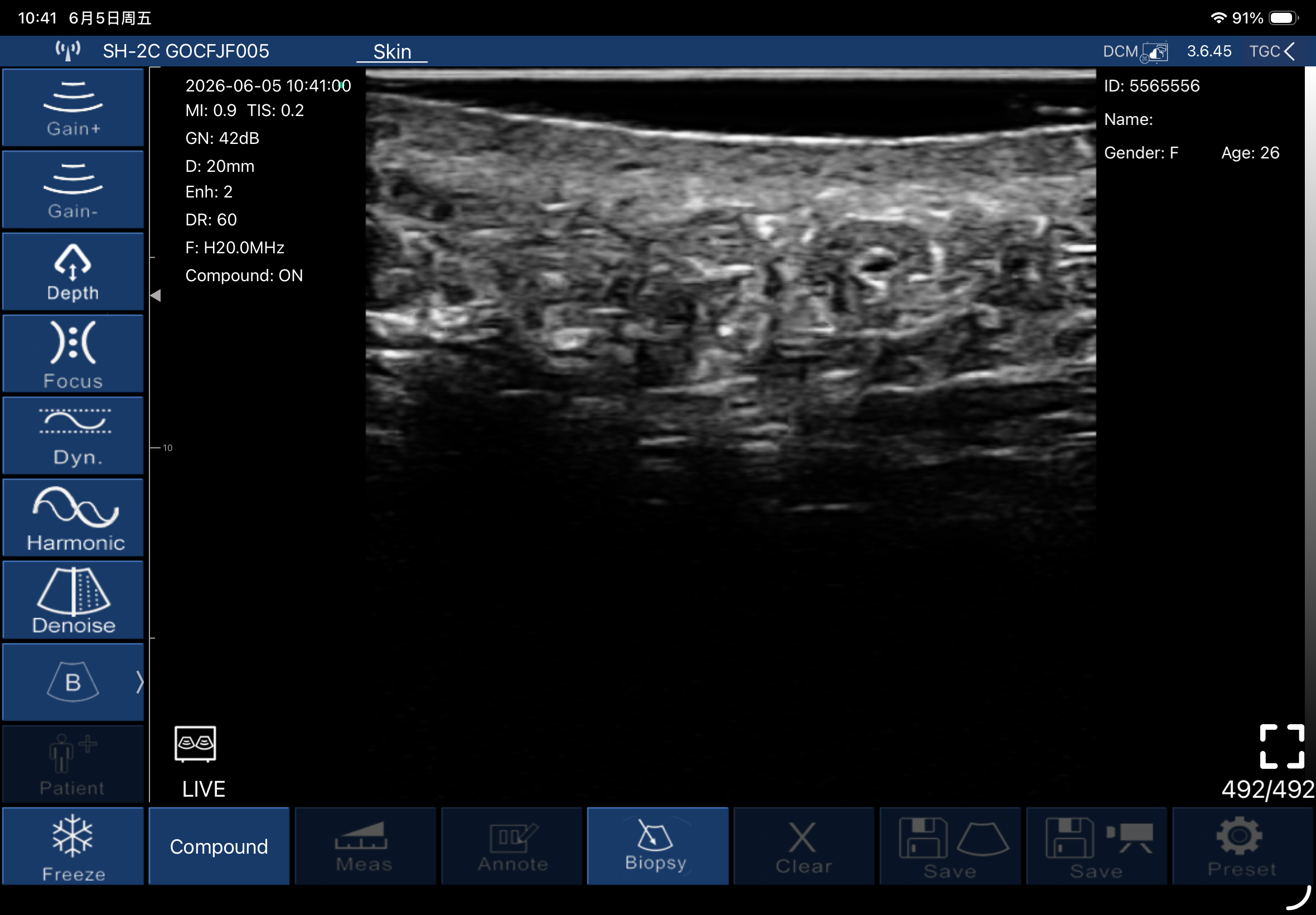 Subcutaneous fat lobules and septae · B-mode · L20Pro · Linear probe scan preview