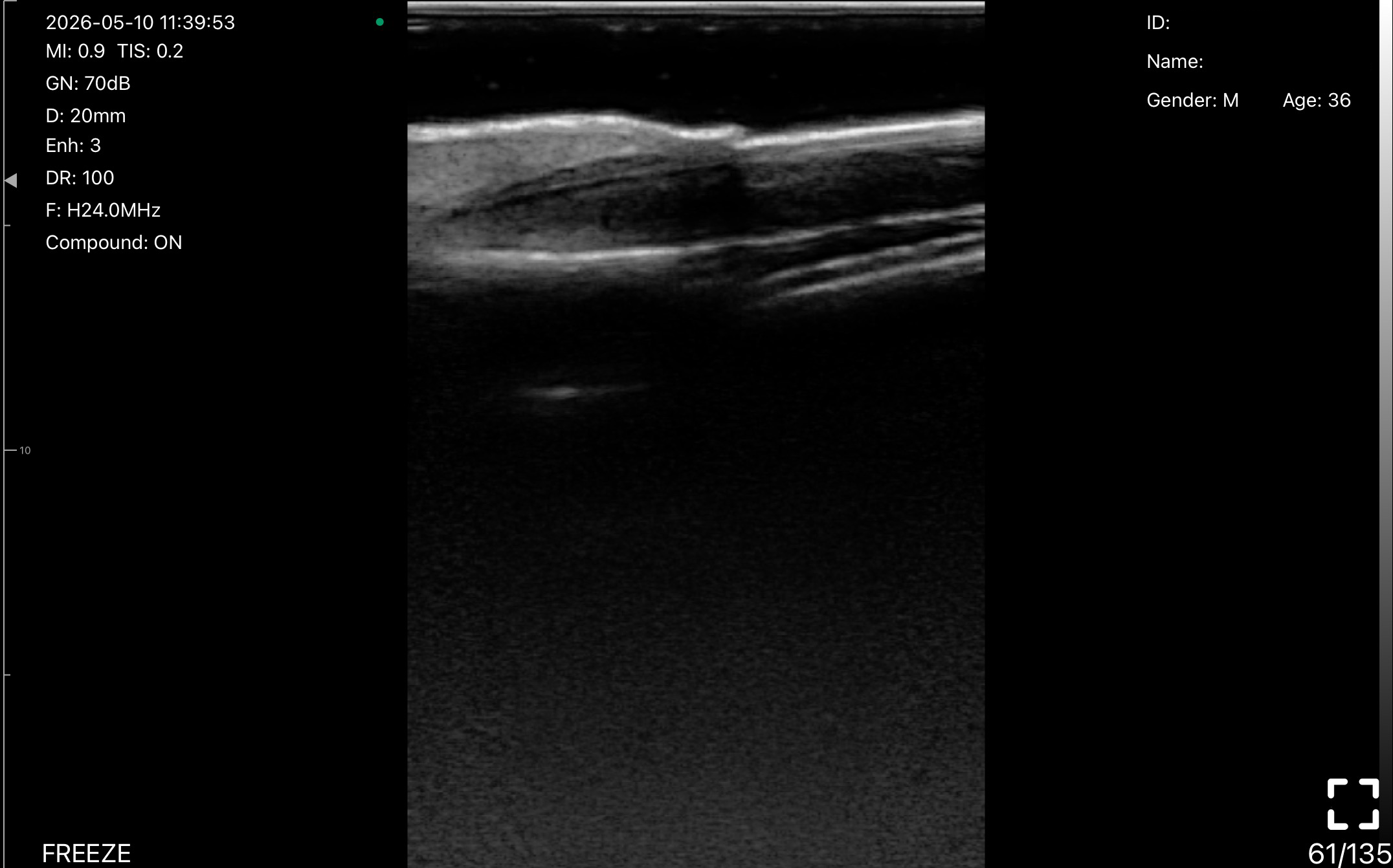 Nail plate, nail bed and distal phalanx · B-mode · L24Pro scan preview
