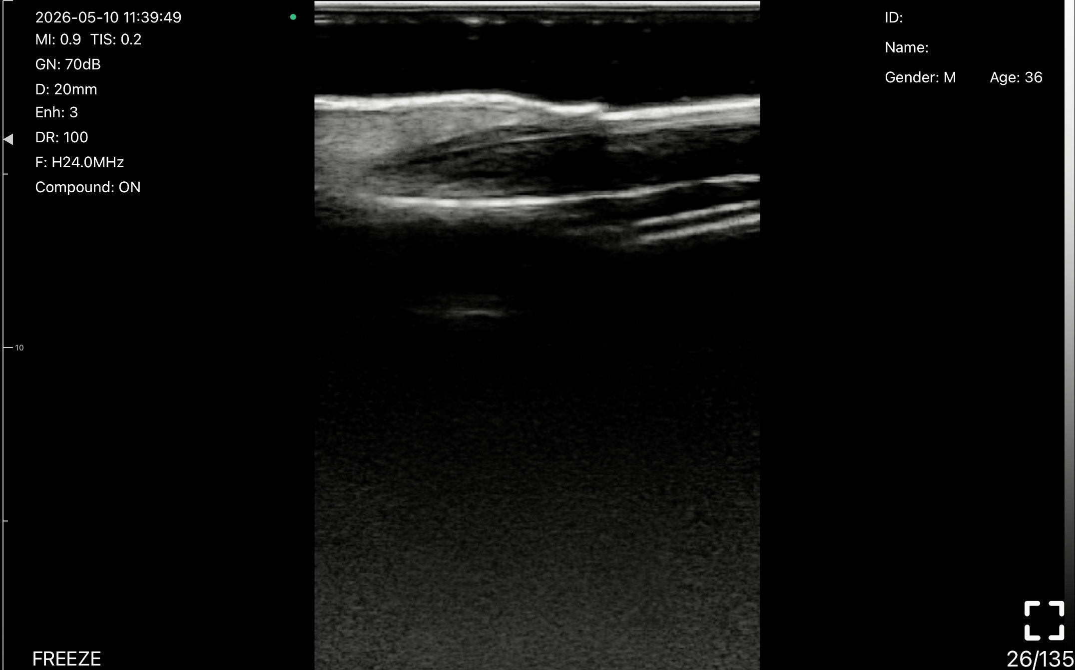 Nail matrix and nail bed · B-mode · L24Pro · Linear probe scan preview
