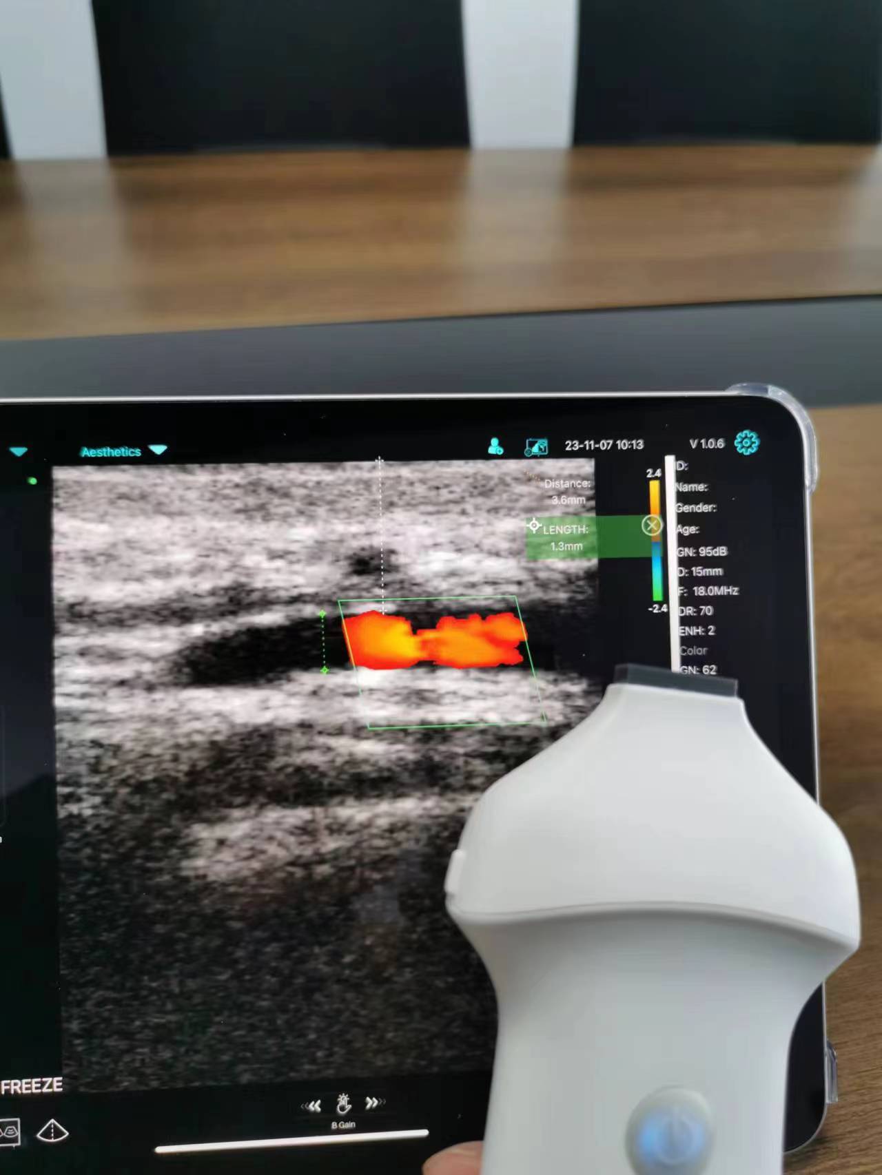Dermal vessel with on-screen measurement · Color Doppler · L20Pro scan preview