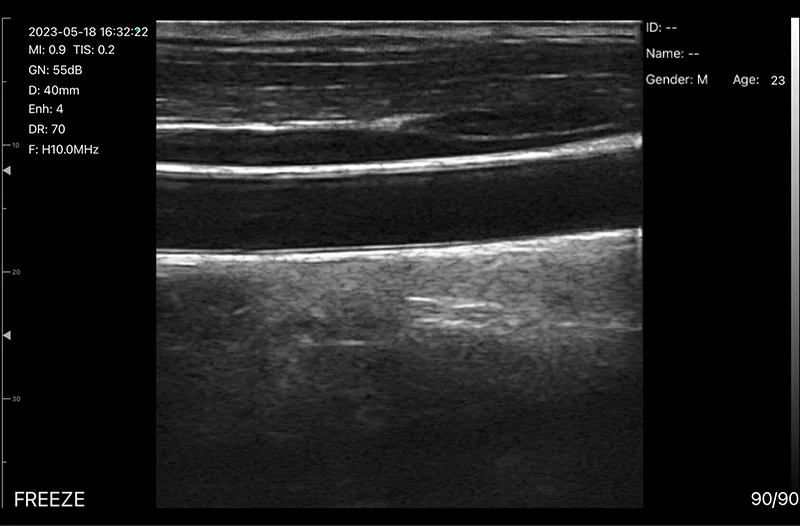 Carotid artery · B-mode · D3Ultra · Linear probe scan preview