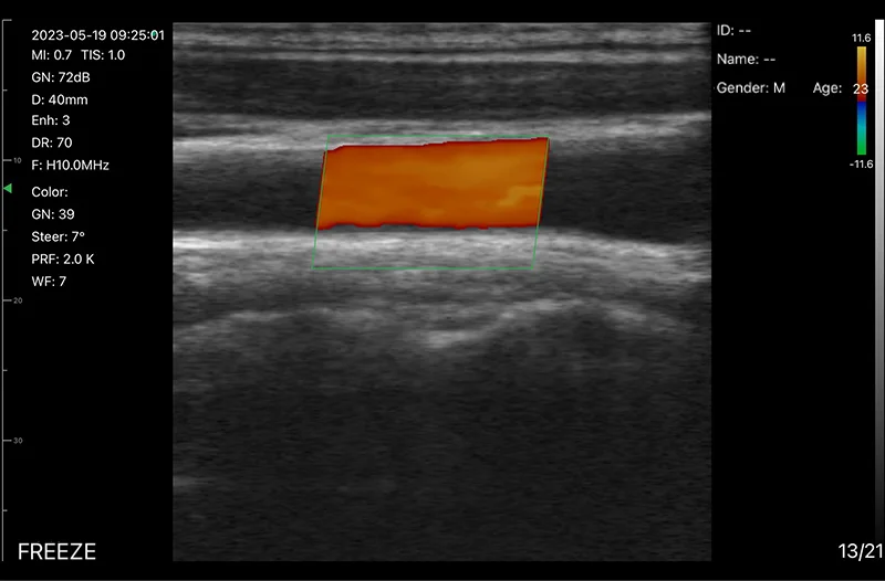 Carotid artery · Color Doppler · D3Ultra · 10 MHz scan preview