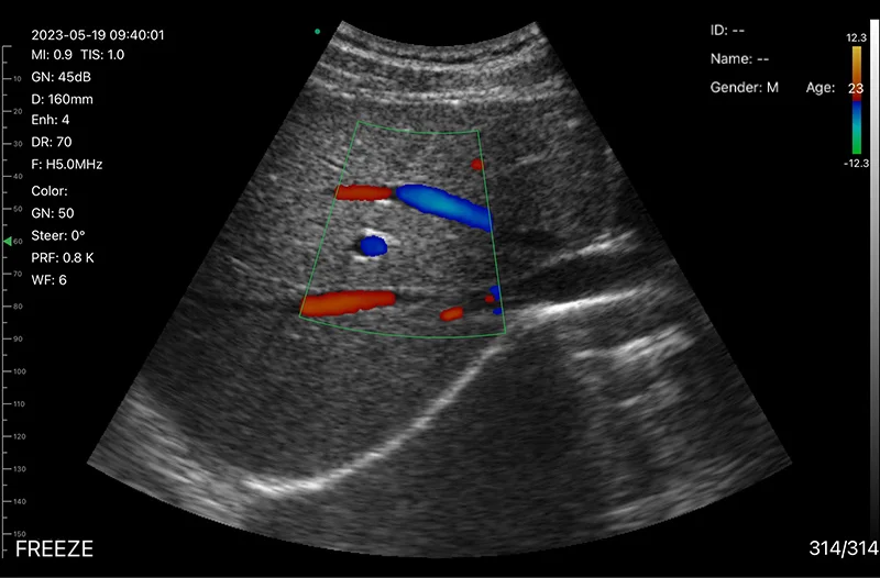 Liver vessels · Color Doppler · D3Ultra · 5 MHz scan preview
