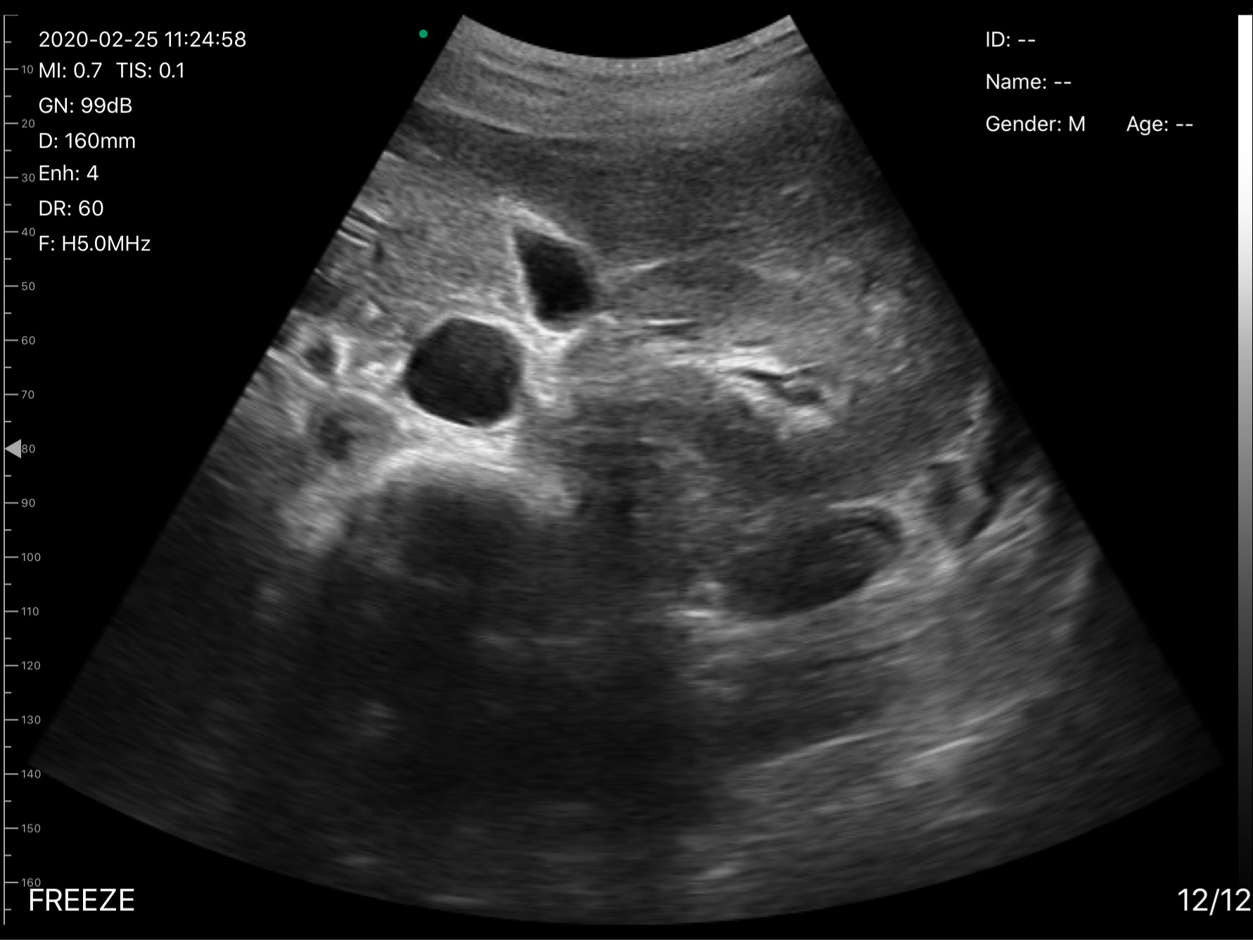Porta hepatis vessels · B-mode · D3Pro · 5 MHz scan preview