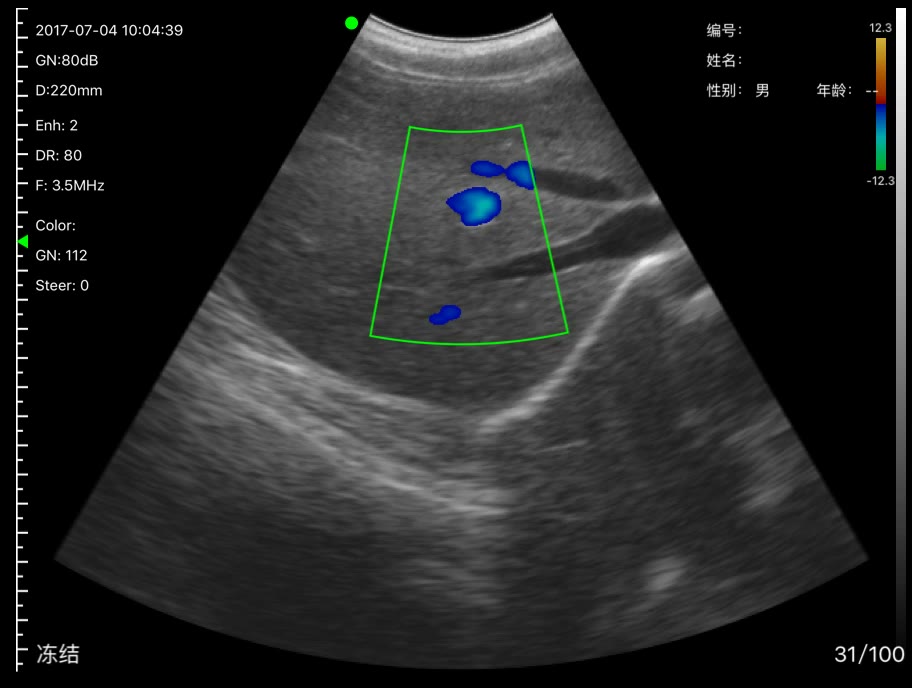 Abdominal vessels · B-mode · C5SH · 3.5 MHz scan preview