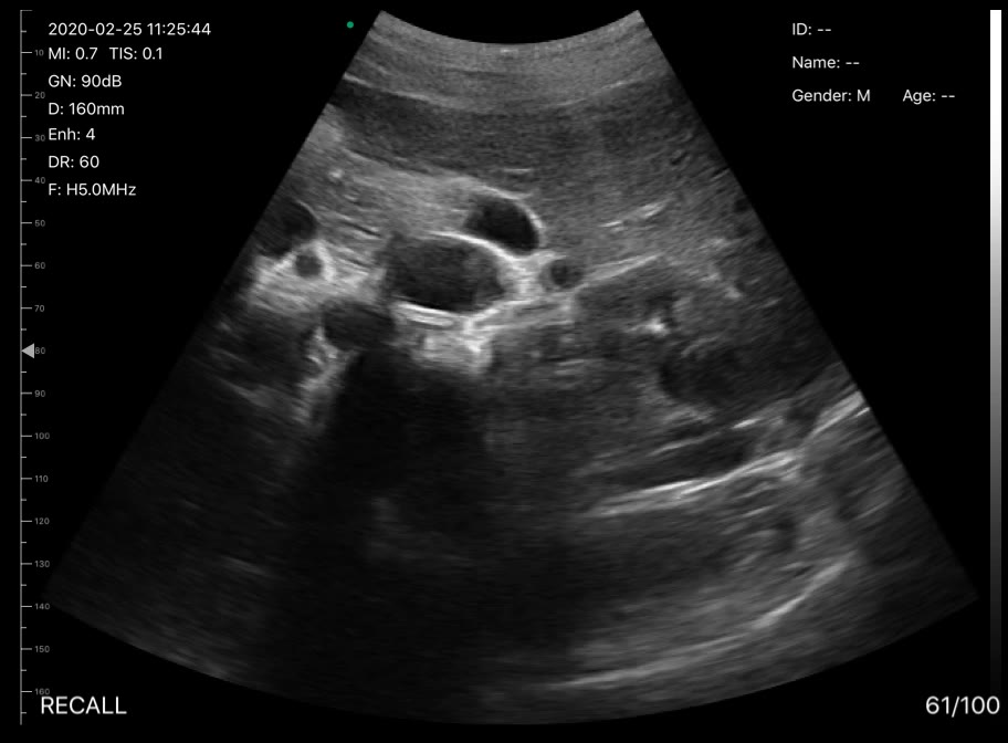 Porta hepatis · B-mode · D3Pro · 5 MHz scan preview