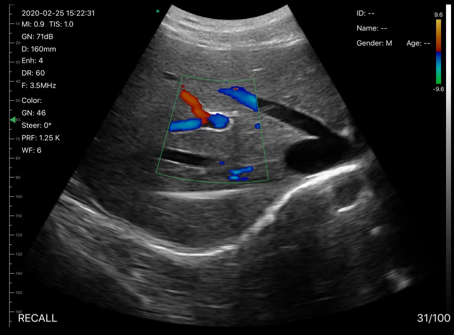 Portal and hepatic veins · B-mode · D3Pro · 3.5 MHz scan preview