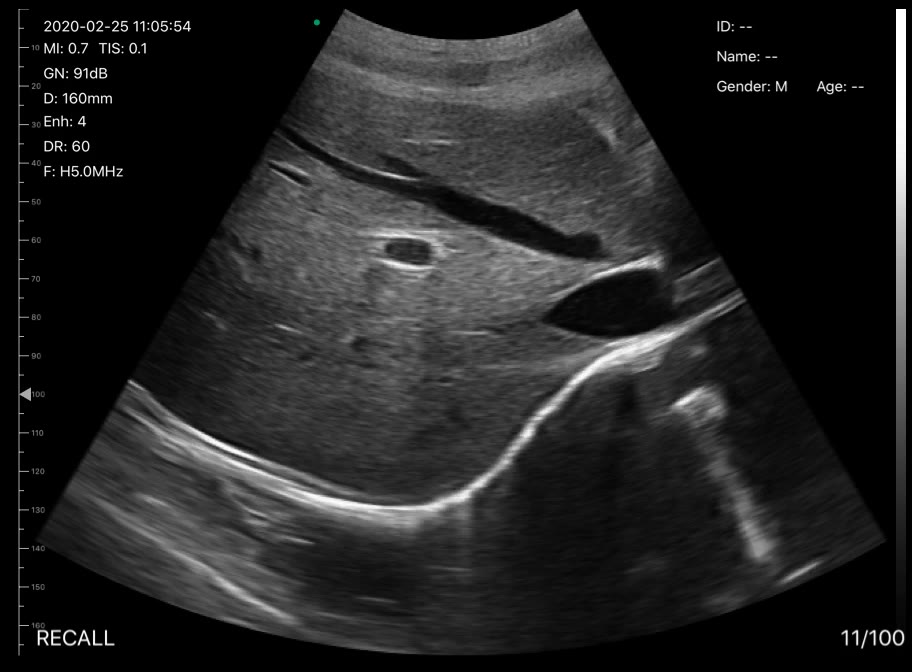 Hepatic vein draining into the IVC · B-mode · D3Pro · 5 MHz scan preview
