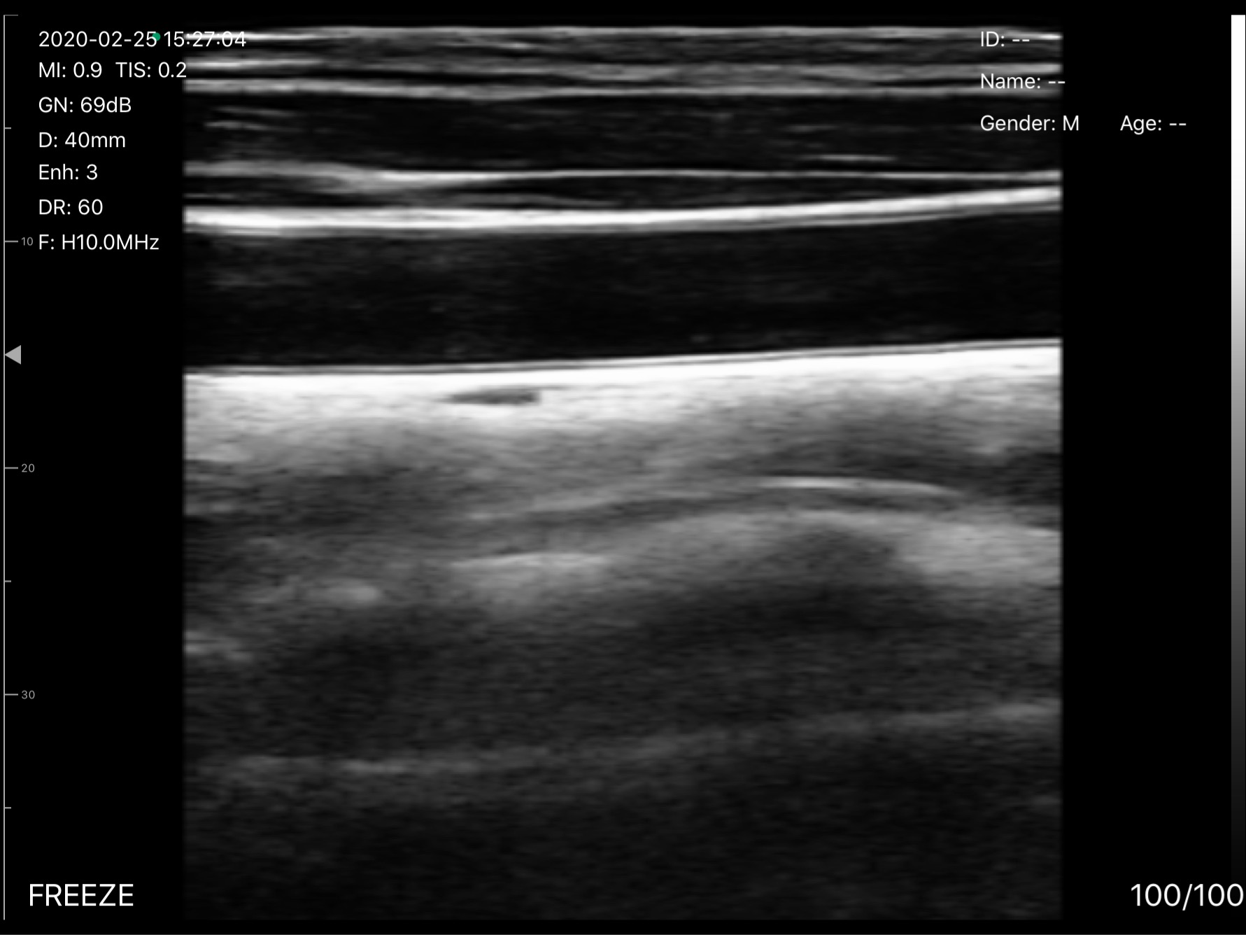 Carotid artery · B-mode · D3Pro · 10 MHz scan preview